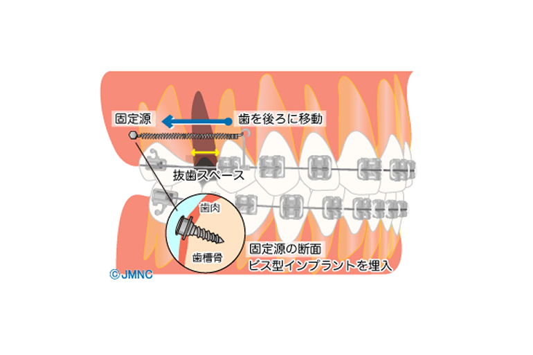 インプラント矯正
