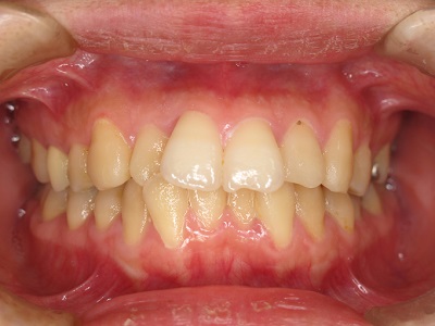 Before