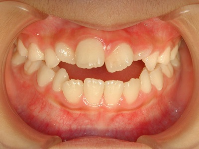 Before